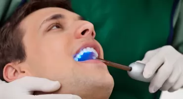 Bonding zębów – szybki sposób na piękny uśmiech bez ingerencji w szkliwo